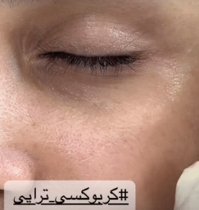 نمونه کربوکسی تراپی دکتر زهرا نورانی