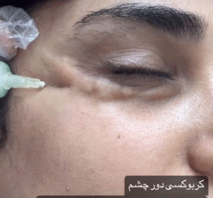 نمونه کربوکسی تراپی دکتر زهرا نورانی