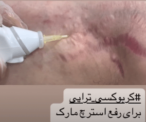 نمونه کربوکسی تراپی دکتر زهرا نورانی