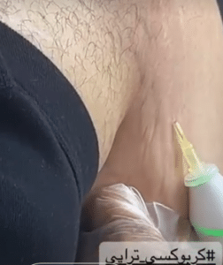 نمونه کربوکسی تراپی دکتر زهرا نورانی