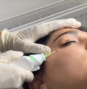 نمونه کربوکسی تراپی دکتر زهرا نورانی