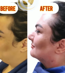 نمونه ساکشن غبغب دکتر امید یوسف تژاد