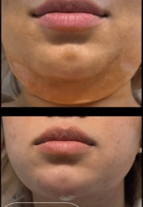 نمونه ساکشن غبغب دکتر امید یوسف تژاد