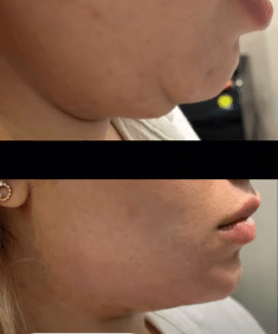 نمونه ساکشن غبغب دکتر امید یوسف تژاد