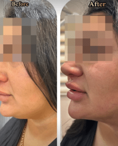 نمونه ساکشن غبغب دکتر امید یوسف تژاد