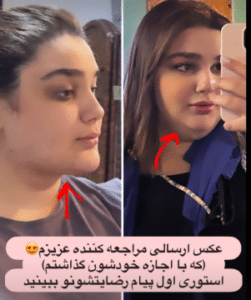 نمونه ساکشن غبغب دکتر مینا ملا احمدی