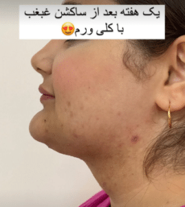 نمونه ساکشن غبغب دکتر مینا ملا احمدی