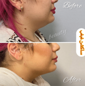 نمونه ساکشن غبغب دکتر مینا ملا احمدی