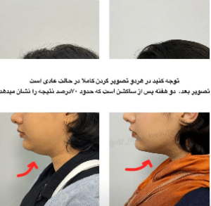 نمونه ساکشن غبغب دکتر مینا ملا احمدی