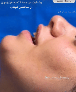 نمونه ساکشن غبغب دکتر مینا ملا احمدی