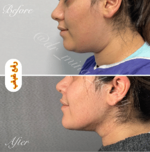 نمونه ساکشن غبغب دکتر مینا ملا احمدی