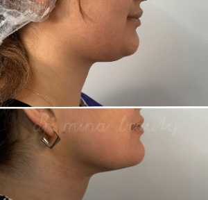 نمونه ساکشن غبغب دکتر مینا ملا احمدی