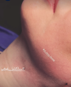 نمونه ساکشن غبغب دکتر مینا ملا احمدی