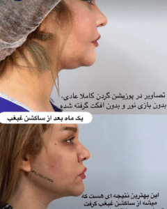 نمونه ساکشن غبغب دکتر مینا ملا احمدی