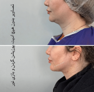 نمونه ساکشن غبغب دکتر مینا ملا احمدی