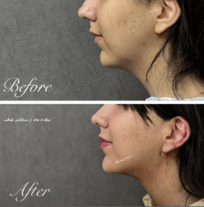 نمونه ساکشن غبغب دکتر مینا ملا احمدی