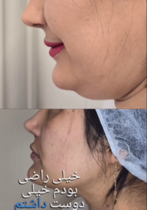 نمونه ساکشن عبعب دکتر محمود جعفری کلینیک رز سفید