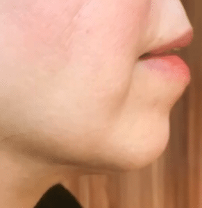 نمونه ساکشن غبغب دکتر قاسم رحمت پور رکنی