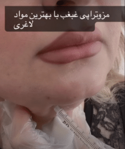 نمونه مزو غبغب مرکز آرا پوست ساریث