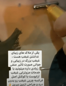 نمونه مزو غبغب مرکز آرا پوست ساریث