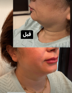 نمونه مزو غبغب مرکز آرا پوست ساریث