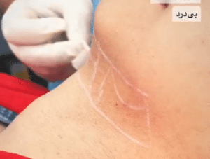 نمونه مزوتراپی غبغب کلینیک کاژه