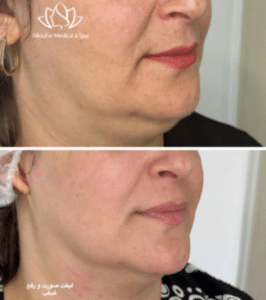 نمونه هایفو غبغب کلینیک زیبایی نیلوفر