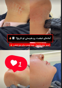 نمونه تزریق چربی سوز غبغب کلینیک زیبایی نیلوفر