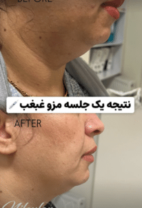 نمونه تزریق چربی سوز غبغب کلینیک زیبایی نیلوفر