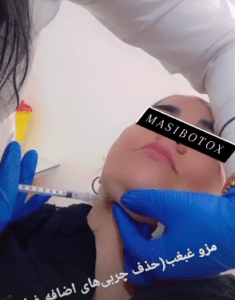 نمونه تزریق چربیسوز غبغب کلینیک زیبایی سام