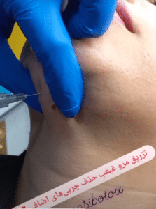 نمونه تزریق چربیسوز غبغب کلینیک زیبایی سام