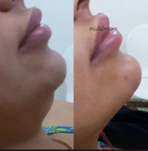 نمونه تزریق چربیسوز غبغب کلینیک زیبایی سام