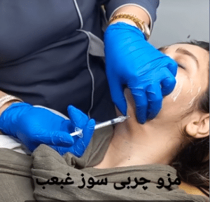 نمونه تزریق چربیسوز غبغب کلینیک زیبایی سام