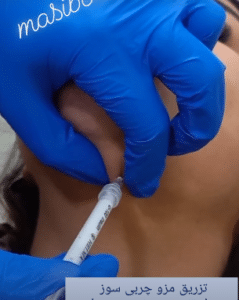 نمونه تزریق چربیسوز غبغب کلینیک زیبایی سام