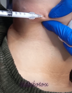 نمونه تزریق چربیسوز غبغب کلینیک زیبایی سام