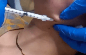 نمونه تزریق چربیسوز غبغب کلینیک زیبایی سام