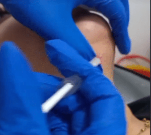 نمونه تزریق چربیسوز غبغب کلینیک زیبایی سام