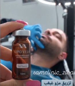 نمونه تزریق چربیسوز غبغب کلینیک زیبایی سام