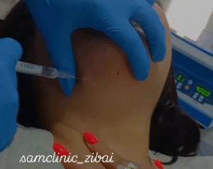 نمونه تزریق چربیسوز غبغب کلینیک زیبایی سام