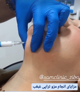نمونه تزریق چربیسوز غبغب کلینیک زیبایی سام