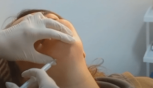 نمونه تزریق چربیسوز غبغب کلینیک زیبایی سام