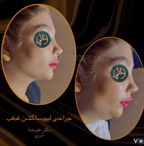 نمونه لیپوساکشن غبغب دکتر علیرضا آذری