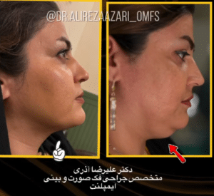 نمونه لیپوساکشن غبغب دکتر علیرضا آذری