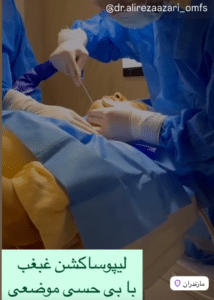 نمونه لیپوساکشن غبغب دکتر علیرضا آذری