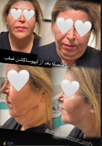 نمونه لیپوساکشن غبغب دکتر علیرضا آذری