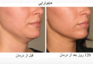 نمونه هایفو غبغب دکتر نرگس رستمیان