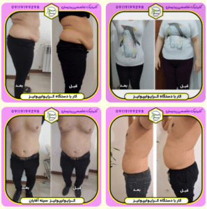 نمونه کرایولیپولیز لاغری کلینیک پردیسان