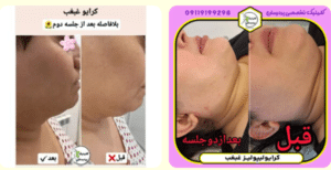 نمونه کرایولیپولیز لاغری کلینیک پردیسان