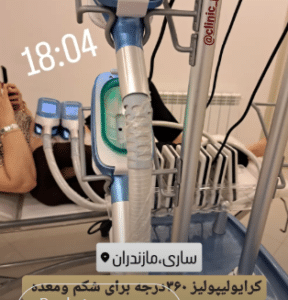 نمونه کرایولیپولیز لاغری کلینیک پردیسان