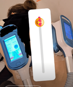 نمونه کرایولیپولیز لاغری کلینیک پردیسان